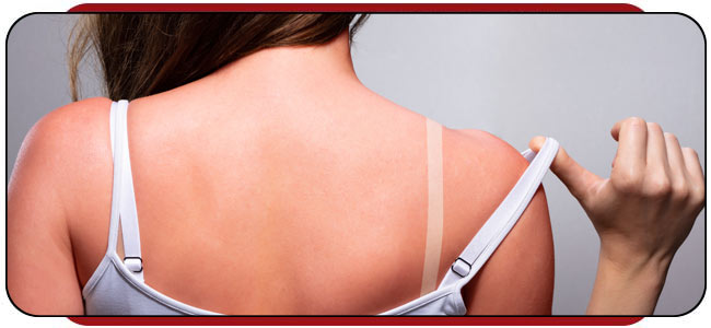 Sunburn Treatment Near Me in Rocky Mount, NC Sunburn Treatment Near Me in Rocky Mount, NC