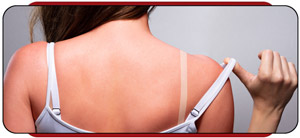 Sunburn Treatment Near Me in Rocky Mount, NC Sunburn Treatment Near Me in Rocky Mount, NC