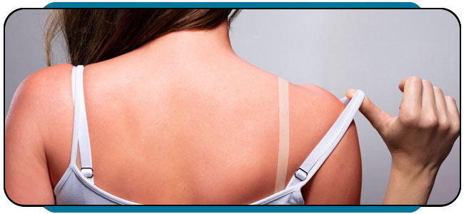 Sunburn Treatment Near Me in Rocky Mount, NC Sunburn Treatment Near Me in Rocky Mount, NC